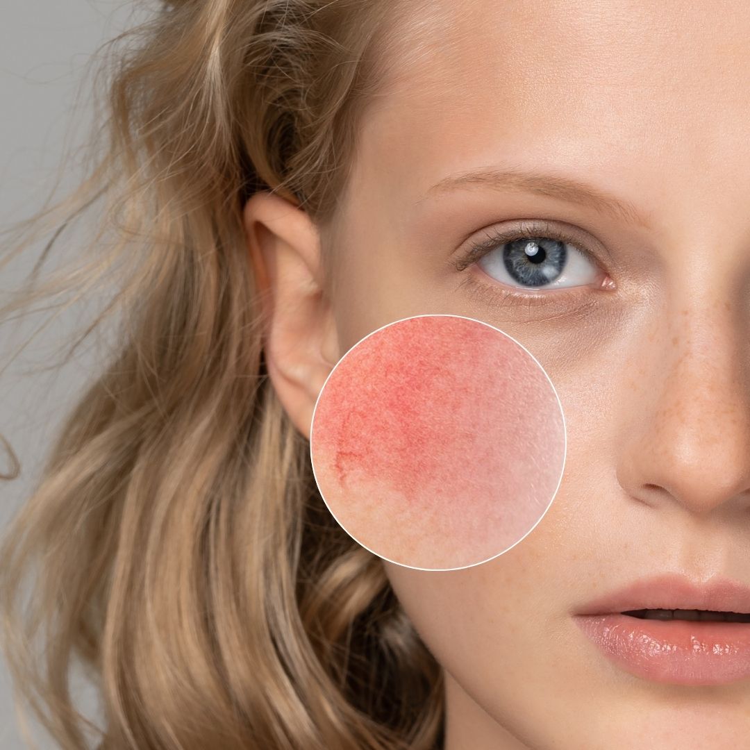 Daily Couperose Serum 30ml