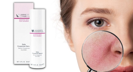 Effektive Gesichtspflege bei Couperose und anfänglicher Rosazea: Entdecke die beruhigende Kraft von SENSITIVE SKIN