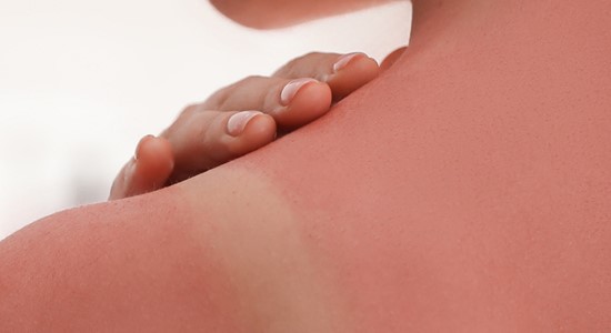 Treat sunburn correctly: The best tips for quick relief and effective care