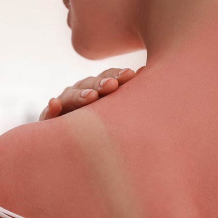 So linderst Du Deinen Sonnenbrand: Die besten Tipps für sofortige Hilfe und intensive Pflege!